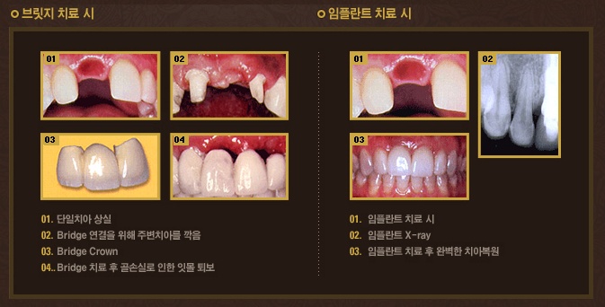 브릿지 임플란트 비교 도식