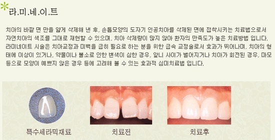 라미네이트 치료 전후 이미지